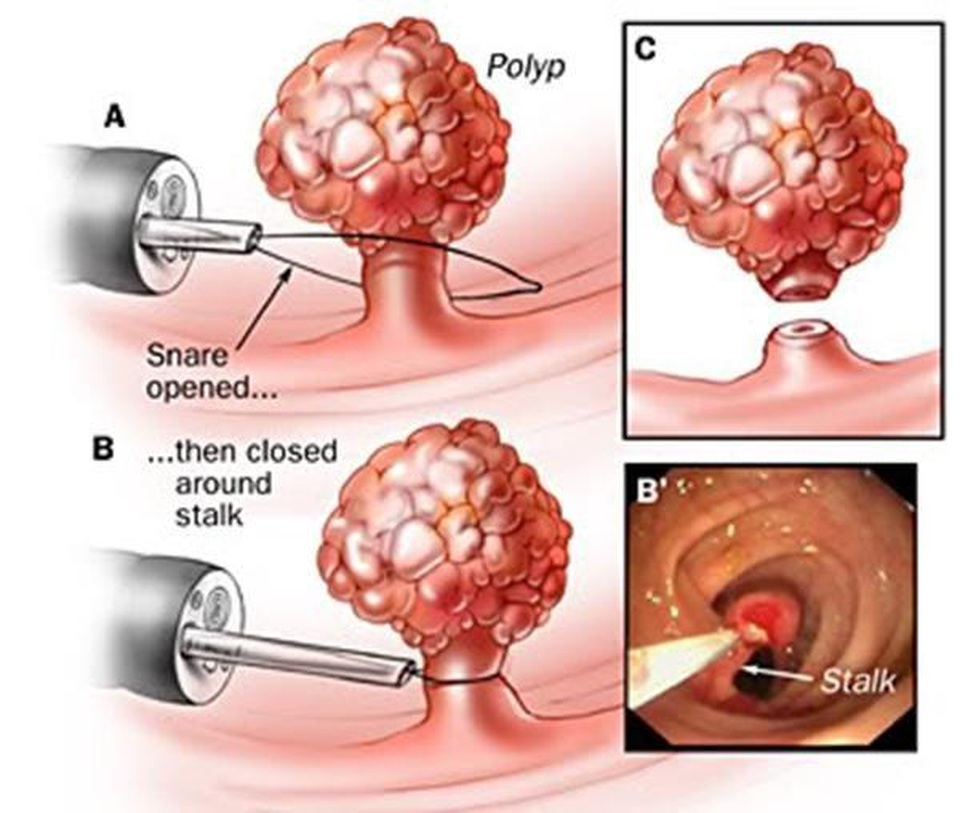 Polyp đại tràng có tiến triển thành ung thư? - 1 Polyp đại tràng có tiến triển thành ung thư? - 1