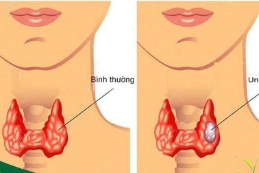 Tiên lượng điều trị ung thư tuyến giáp ở trẻ em