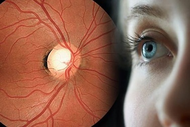 Căn bệnh được mệnh danh "kẻ đánh cắp thị lực thầm lặng"