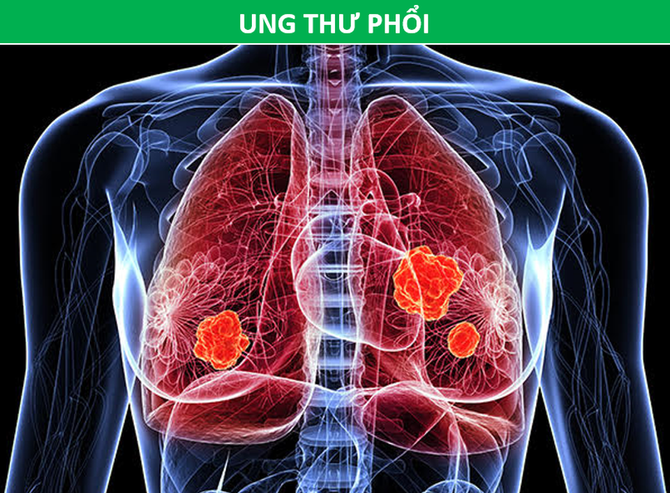 Những phương pháp tầm soát ung thư giúp bạn chủ động trước bệnh tật - 7 Những phương pháp tầm soát ung thư giúp bạn chủ động trước bệnh tật - 7