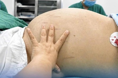 Thiếu nữ 19 tuổi tưởng béo bụng, bác sĩ hút 10 lít dịch từ khối u khổng lồ