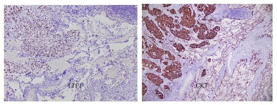 Hiếm gặp: Phát hiện 2 loại ung thư trên cùng một thùy phổi - 1