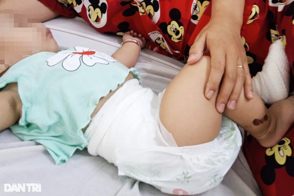 Bé gái 7 tháng tuổi rơi xuống lò than sưởi ấm mẹ đặt dưới giường, bỏng nặng - 2 Bé gái 7 tháng tuổi rơi xuống lò than sưởi ấm mẹ đặt dưới giường, bỏng nặng - 2