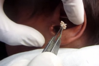 Hàng trăm con giòi làm tổ trong tai một thanh niên Ấn Độ