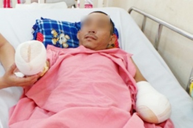 Cụt cả 2 tay vì làm nhà bên đường điện