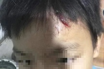 Xác minh bé trai 10 tuổi nghi bị mẹ kế bạo hành lần 2