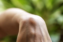 Loại ung thư thường gặp ở người trẻ có triệu chứng dễ lầm bệnh vặt