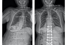 Đục xương sửa trục, cứu bệnh nhân biến dạng cột sống