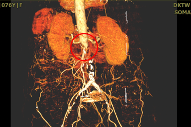 Nguy cơ hoại tử chân vì tắc động mạch chủ bụng