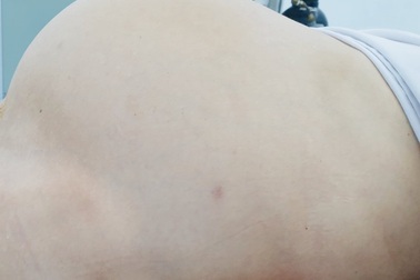 Từ chối can thiệp sớm, bệnh nhân mang khối u ác tính khổng lồ