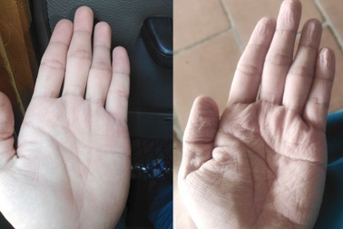 Những đôi bàn tay "biến dạng" tại "chảo lửa" Covid-19 ở Bắc Giang