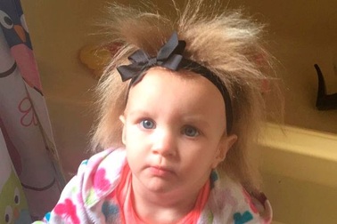 Cô bé tóc dựng đứng vì mắc hội chứng lạ