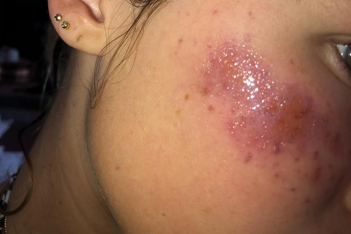 Cô gái trẻ bị mù tạm thời và sẹo vĩnh viễn trên mặt vì tự xăm tàn nhang - 2