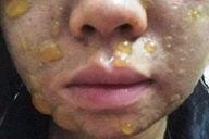 Nhiều người nhập viện vì mặt sưng húp, sạm đen sau peel da theo mạng xã hội