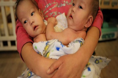 Trung Quốc: Cặp song sinh dính liền bụng bị bố mẹ bỏ rơi 