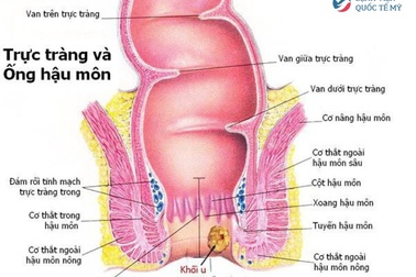 Thoát khỏi nỗi sợ ung thư hậu môn nhờ kết hợp các phương pháp điều trị chuẩn Mỹ