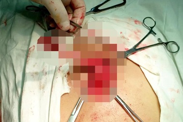 Lấy bàn chải dài 19 cm từ bụng bệnh nhân chỉ còn “cách cái chết vài phút”