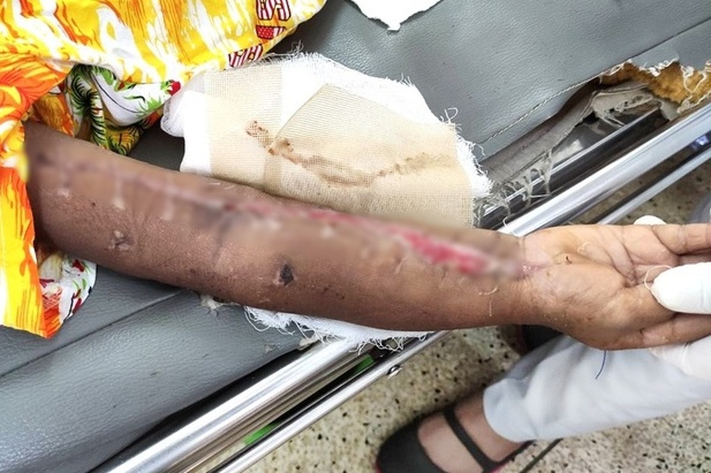 Nhiều trẻ viêm mô tế bào nhập viện ở TPHCM vì cha mẹ tự ý đắp lá thuốc - 2 Nhiều trẻ viêm mô tế bào nhập viện ở TPHCM vì cha mẹ tự ý đắp lá thuốc - 2