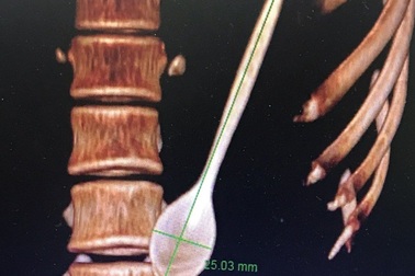 Cấp cứu thành công hai bệnh nhân nuốt phải thìa nhựa, răng giả