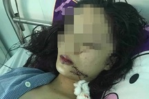 Thiếu nữ 18 tuổi bị 3 cô gái xông vào khống chế, dùng dao rạch mặt