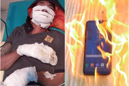 Báo động "cụt tay, hỏng mắt" vì điện thoại phát nổ khi đang sạc