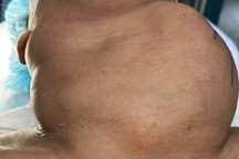 Người phụ nữ biến dạng cơ thể như ễnh ương vì khối bướu 30 năm không mổ