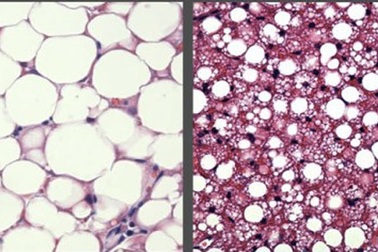 Phát hiện cơ chế "đốt cháy" chất béo sau bữa ăn của não bộ