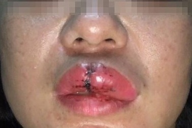 Xử lưu động đối tượng đấm Chủ tịch Hội phụ nữ phường gãy răng