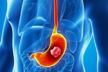 Liệu pháp miễn dịch + hóa trị: Kéo dài thời gian sống cho người ung thư dạ dày