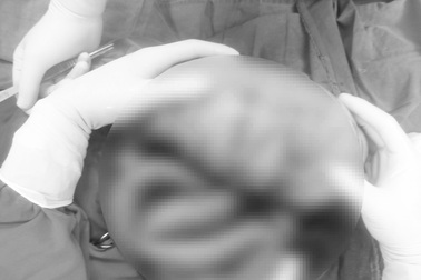 Bé trai suýt vỡ đại tràng vì gia đình chủ quan với triệu chứng táo bón