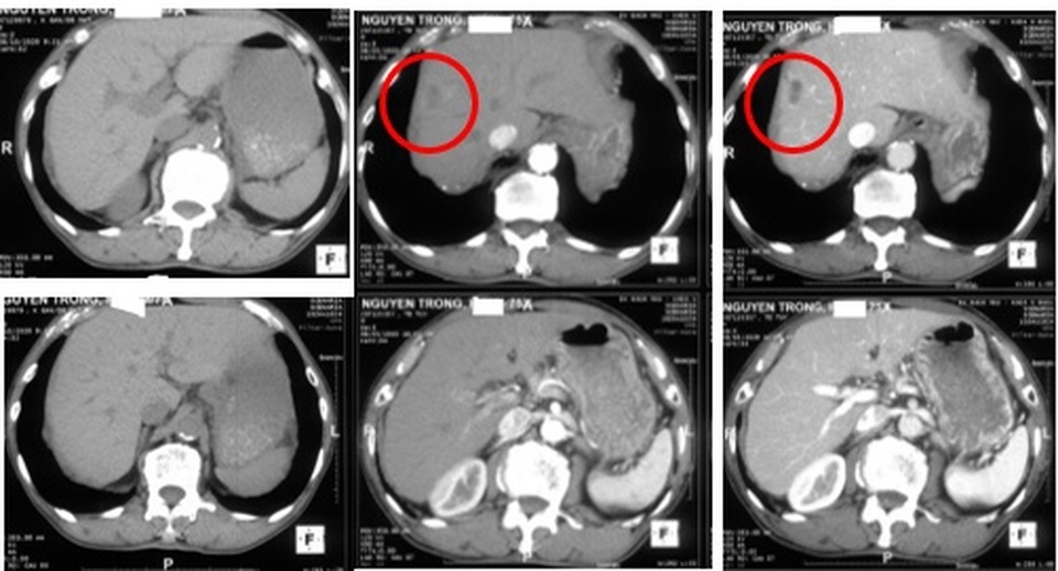 Đau thắt lưng đi khám, bất ngờ phát hiện khối u trong gan - 1 Đau thắt lưng đi khám, bất ngờ phát hiện khối u trong gan - 1