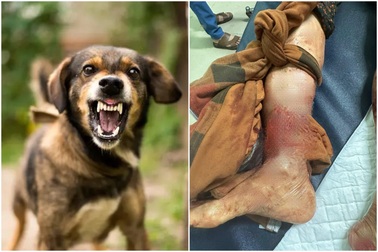 Hà Nội: Một người bị chó nhà cắn gần đứt rời bàn chân