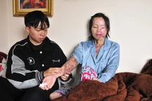 Người phụ nữ cạn nước mắt vì hình hài biến dạng sau "cơn mưa" axit