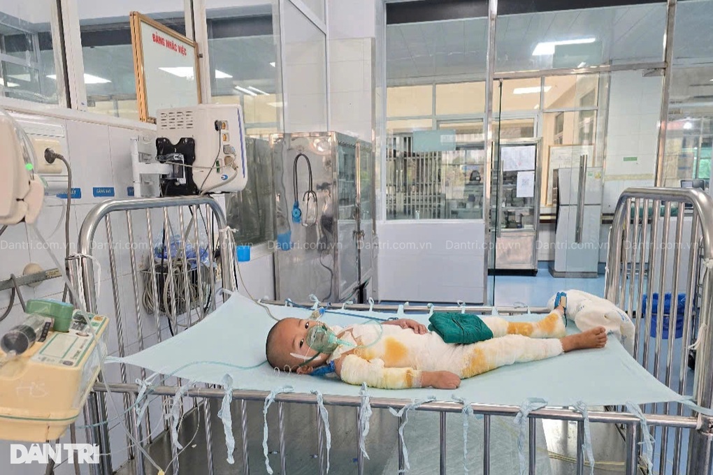 Ngã vào nồi cám lợn nóng, bé 3 tuổi dân tộc Mông bỏng 48% cơ thể - 1 Ngã vào nồi cám lợn nóng, bé 3 tuổi dân tộc Mông bỏng 48% cơ thể - 1