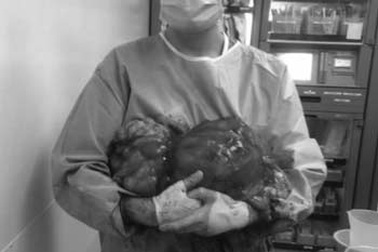 Phẫu thuật thành công khối u mỡ ác tính nặng hơn 20kg trong ổ bụng