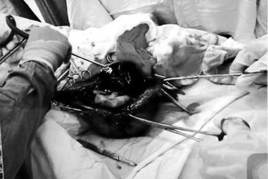 Cứu sống sản phụ mang thai ngoài tử cung hiếm gặp