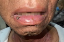 Cảnh báo: 90% bệnh nhân gặp vấn đề nguy hiểm này sau khi xạ trị ung thư