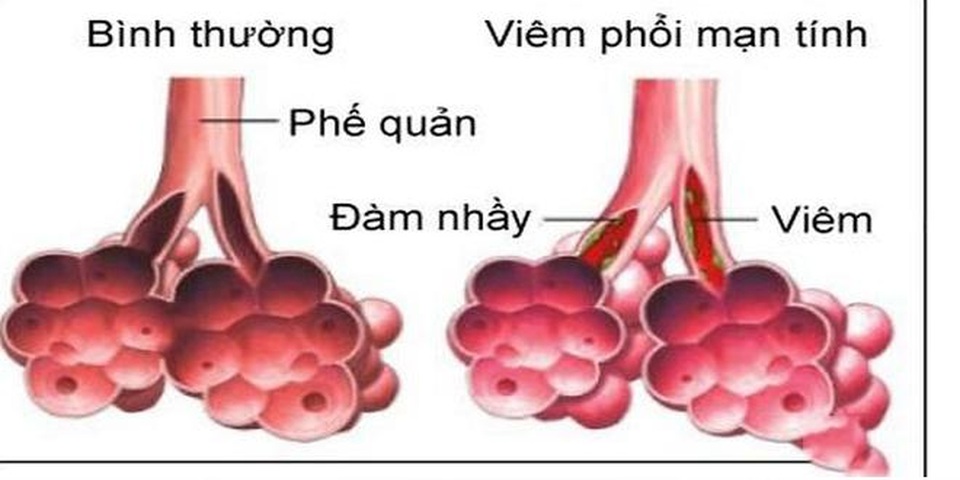 Bảo Phế Vương - Giải pháp “vàng” cho người bị bệnh viêm phổi - 1 Bảo Phế Vương - Giải pháp “vàng” cho người bị bệnh viêm phổi - 1