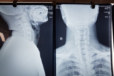 Phẫu thuật lấy mảnh sắt găm vào cổ thợ sửa ô tô