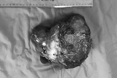 Bé gái 6 tuổi được phát hiện khối u thận đến 2kg vì dấu hiệu bụng tròn như quả mít