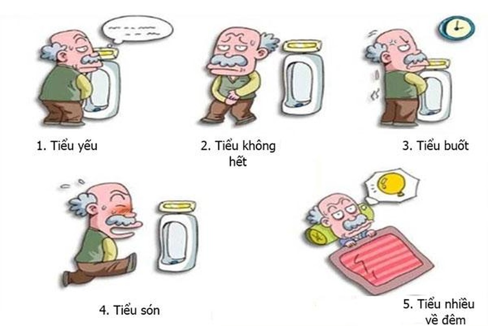Phì đại tiền liệt tuyến: Nguyên nhân, triệu chứng và cách xử lý - 3 Phì đại tiền liệt tuyến: Nguyên nhân, triệu chứng và cách xử lý - 3