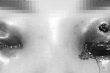 Hà Nội: Cô gái trẻ mù 1 bên mắt vì cắt mí tại spa