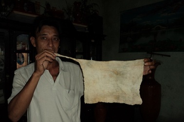 Phát hiện gạc y tế trong bụng bệnh nhân sau phẫu thuật