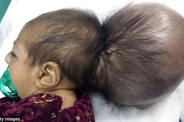 Cứu sống bé gái có 2 đầu 