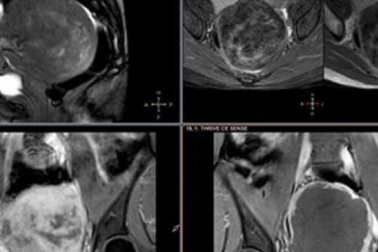 Giảm ham muốn tình dục chỉ vì chủ quan với rối loạn kinh nguyệt