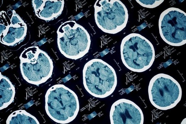 Chẩn đoán sai, cậu bé 13 tuổi tử vong do nhiễm trùng xoang lan lên não