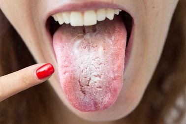 Lưỡi xuất hiện triệu chứng này coi chừng ung thư gan