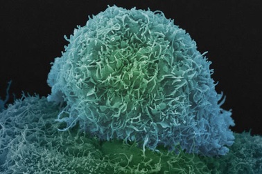 Đầu tư 55 triệu bảng Anh cho nghiên cứu phát hiện sớm ung thư