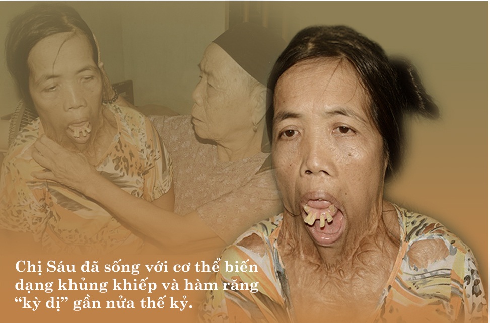 Người đàn bà nửa thế kỉ mang hàm răng kì dị: Tôi nghĩ cuộc đời đã bỏ đi - 2 Người đàn bà nửa thế kỉ mang hàm răng kì dị: Tôi nghĩ cuộc đời đã bỏ đi - 2