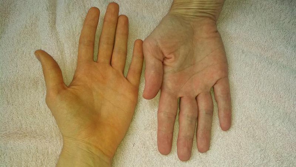 Những dấu hiệu men gan cao thường gặp nhất - 2 Những dấu hiệu men gan cao thường gặp nhất - 2